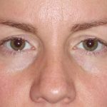 Eyelid Lift- Upper Before & After Patient #765