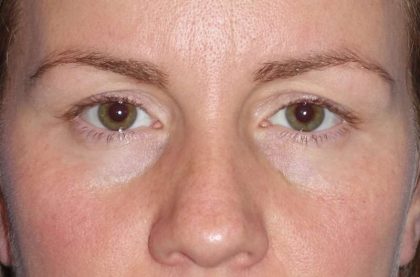 Eyelid Lift- Upper Before & After Patient #765