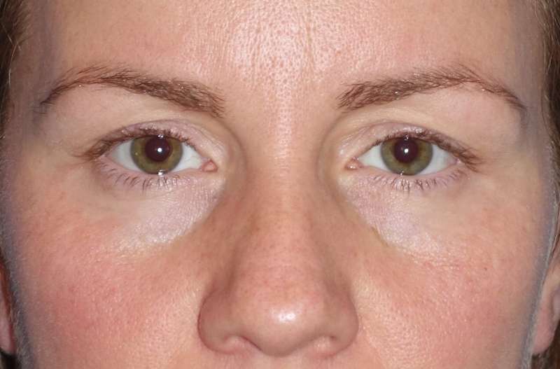 Eyelid Lift- Upper Before & After Patient #765
