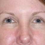 Eyelid Lift- Upper Before & After Patient #776