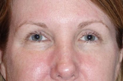 Eyelid Lift- Upper Before & After Patient #776