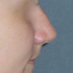 Rhinoplasty Before & After Patient #787