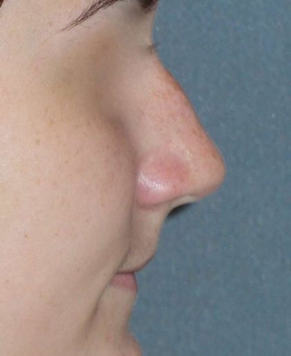 Rhinoplasty Before & After Patient #787