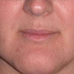 Juv&eacute;derm - Lips Before & After Patient #654