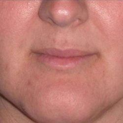 Juvéderm - Lips Before & After Patient #654