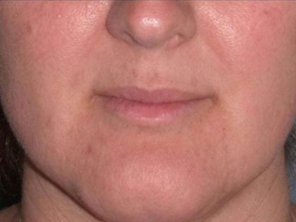 Juvéderm - Lips Before & After Patient #654
