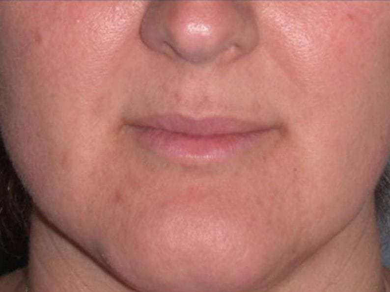 Juv&eacute;derm - Lips Before & After Patient #654