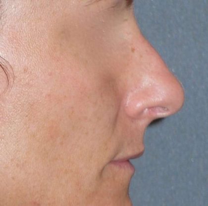 Rhinoplasty Before & After Patient #798
