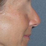 Rhinoplasty Before & After Patient #809
