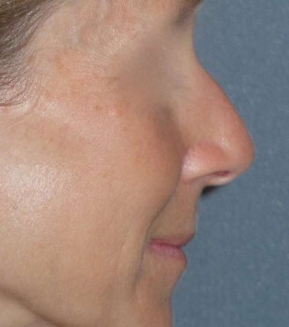 Rhinoplasty Before & After Patient #809