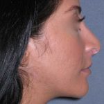 Rhinoplasty Before & After Patient #816