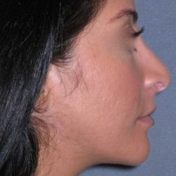 Rhinoplasty Before & After Patient #816