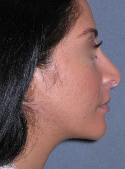Rhinoplasty Before & After Patient #816