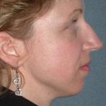 Rhinoplasty Before & After Patient #823