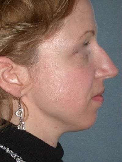 Rhinoplasty Before & After Patient #823