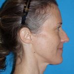 Rhinoplasty Before & After Patient #834