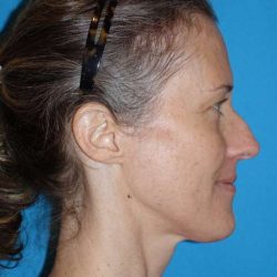 Rhinoplasty Before & After Patient #834