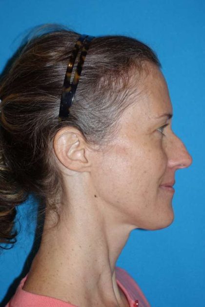 Rhinoplasty Before & After Patient #834