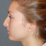 Rhinoplasty Before & After Patient #845