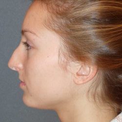 Rhinoplasty Before & After Patient #845
