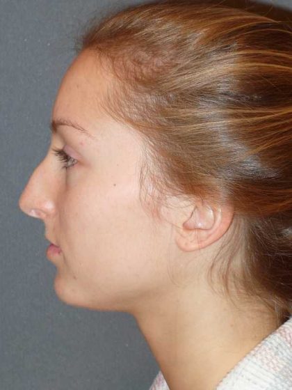 Rhinoplasty Before & After Patient #845