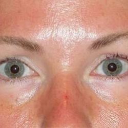 Juvéderm - Tear Troughs Before & After Patient #648