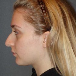 Rhinoplasty Before & After Patient #856