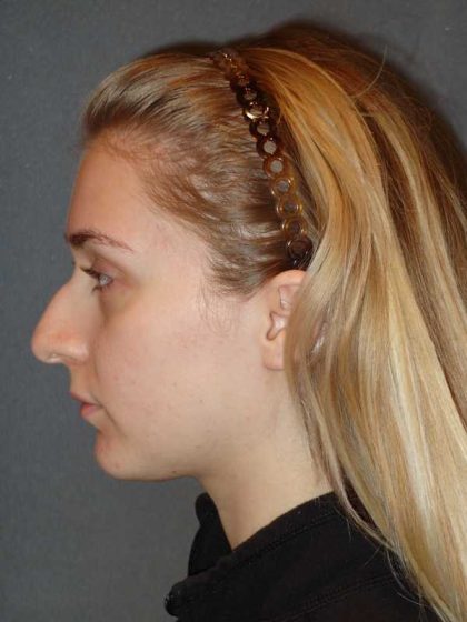 Rhinoplasty Before & After Patient #856