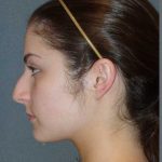 Rhinoplasty Before & After Patient #867