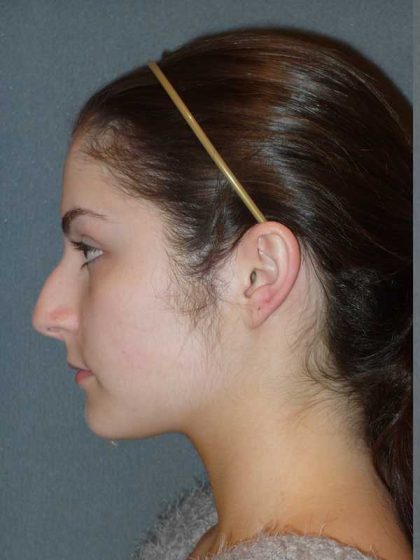 Rhinoplasty Before & After Patient #867