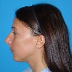 Rhinoplasty Before & After Patient #878