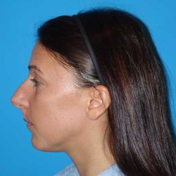 Rhinoplasty Before & After Patient #878