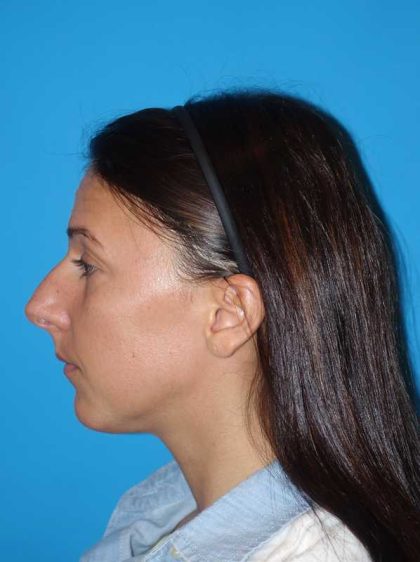 Rhinoplasty Before & After Patient #878