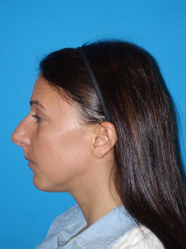 Rhinoplasty Before & After Patient #878