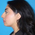 Rhinoplasty Before & After Patient #887