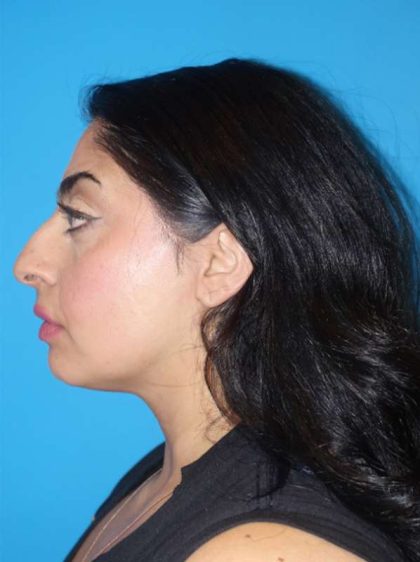 Rhinoplasty Before & After Patient #887