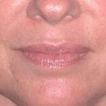 Juv&eacute;derm - Lips Before & After Patient #659