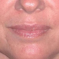 Juvéderm - Lips Before & After Patient #659