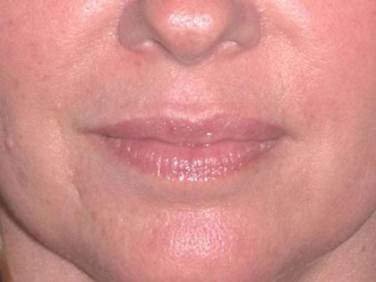 Juvéderm - Lips Before & After Patient #659