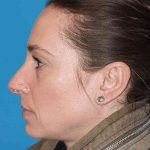 Rhinoplasty Before & After Patient #898