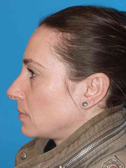Rhinoplasty Before & After Patient #898