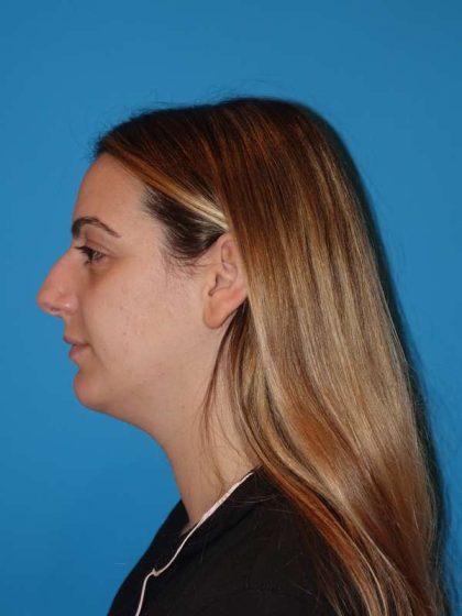Rhinoplasty Before & After Patient #909