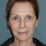 Deep Plane Lower Face & Neck Lift Before & After Patient #920