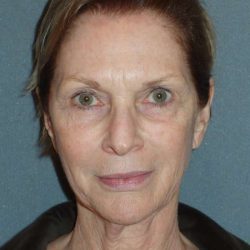 Deep Plane Lower Face & Neck Lift Before & After Patient #920