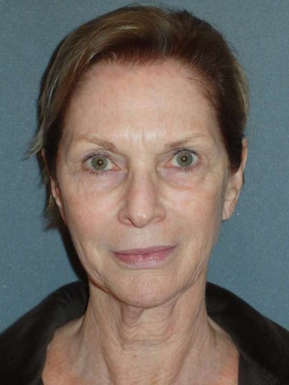 Deep Plane Lower Face & Neck Lift Before & After Patient #920