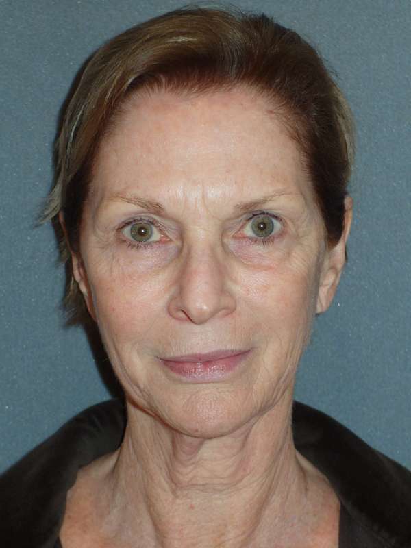 Deep Plane Lower Face & Neck Lift Before & After Patient #920