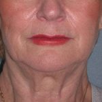 Deep Plane Lower Face & Neck Lift Before & After Patient #936