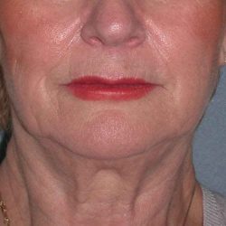 Deep Plane Lower Face & Neck Lift Before & After Patient #936
