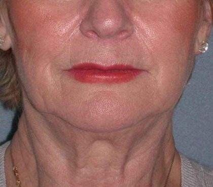 Deep Plane Lower Face & Neck Lift Before & After Patient #936