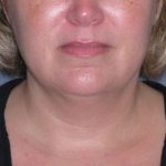 Deep Plane Lower Face & Neck Lift Before & After Patient #947